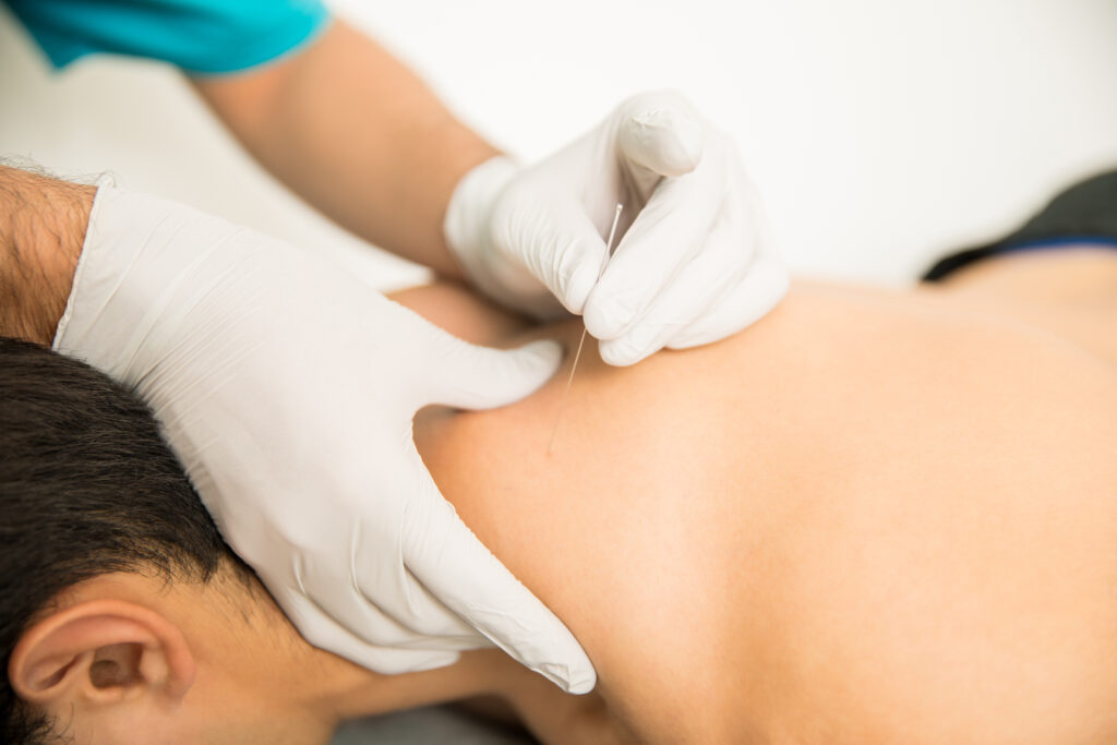 Find Effective Relief for Your Pain with Dry Needling