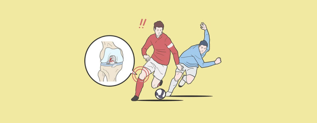Maintaining Knee Stability: Long-Term Care After ACL Reconstruction