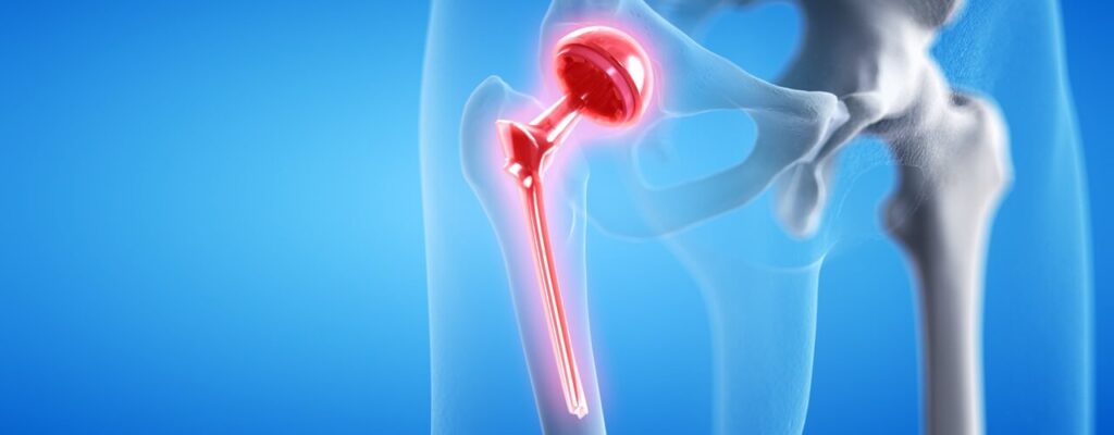 Hip replacement
