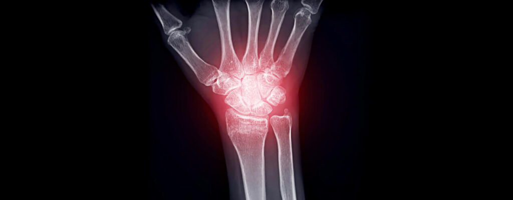 How to Manage Joint Inflammation from Arthritis